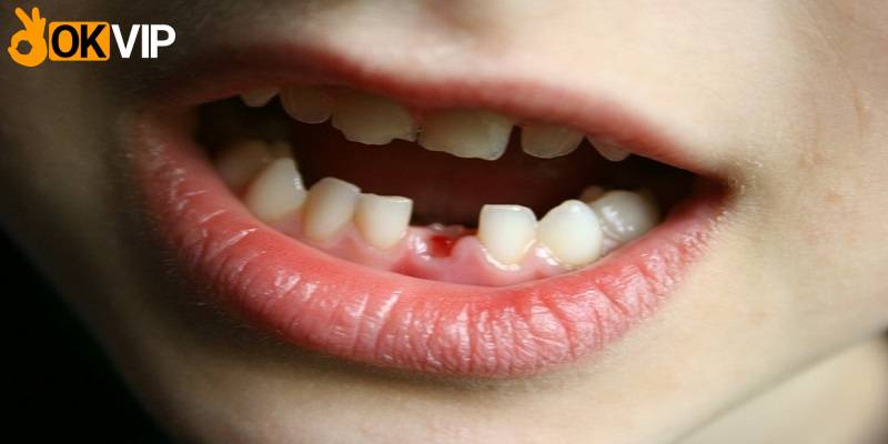 Ý nghĩa của chiêm bao rụng mất răng hàm dưới